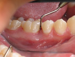 Fig 5. Probing revealed a 10-mm periodontal pocket.