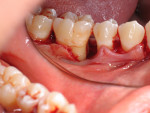 Fig 6. Periodontal surgery revealed severe bone loss and furcation involvement.