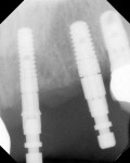 Figure 10  Radiograph of final implant positions.