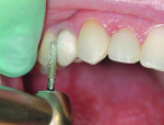 Fig 4. Facial porcelain was removed from tooth No. 5 to allow for composite resin to be bonded to provide better shape and contour.