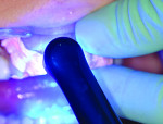 Fig 13. Peak® Universal Bond agent was applied to the etched tooth, air thinned, and light cured for 10 seconds using Valo® LED curing light (Ultradent Products).
