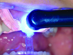 Fig 15. Vit-l-escence composite resin shade Opaque Snow was applied to tooth No. 8 and minimally contoured. Uveneer template was placed over the uncured composite and gently pressed into place. The excess composite from the mesial, distal, and gingival was removed using an IPC. To avoid moving or dislodging the Uveneer template, the excess on the incisal was removed after light curing using an EP polishing disc.