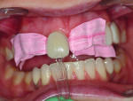 Fig 14. Vit-l-escence composite resin shade Opaque Snow was applied to tooth No. 8 and minimally contoured. Uveneer template was placed over the uncured composite and gently pressed into place. The excess composite from the mesial, distal, and gingival was removed using an IPC. To avoid moving or dislodging the Uveneer template, the excess on the incisal was removed after light curing using an EP polishing disc.