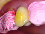 Fig 5. Teflon tape was used to isolate
tooth No. 5. Teflon tape adapts better
to the adjacent teeth and is thin enough
that it does not interfere with establishment
of proximal contacts. KleerViewTM
cheek retractors (Ultradent Products)
were also used for isolation. Porcelain
etch (Ultradent Products) was applied
for 1 minute and then rinsed off.