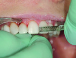 Fig 17. A VisionFlex UF polishing strip was used to smooth any tags of resin or bonding agent. Epitex® polishing strips (GC America) were use to put a high shine on the proximal walls and to prevent bonding during the successive veneer placement. The veneers on teeth Nos. 9 through 11 were approached in the same manner. The veneer on tooth No. 12 was treated the same as tooth No. 5 where the porcelain was reduced, etched with porcelain etch, silanated, and coated with Peak® Universal Bond agent.