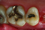 Fig 1. The patient presented with two teeth needing treatment due to decay, leakage, and fractured restorations.