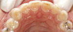 Figure 1  Occlusal view of 23-year-old patient demonstrating severe loss of enamel on the lingual of maxillary anterior teeth. Tooth No. 6 demonstrates proximity to the pulp.