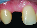 Fig 3. Preoperative frontal and sagittal views. A 27-year-old male fourth-year dental student with frequently failed metal-bonded FDP
replacing teeth Nos. 7 and 10 was referred to the outpatient facility of the University of Texas Health Science Center student clinic. Both bridges had been bonded several times but
failed to remain bonded. Clinical examination revealed that the amount of tooth preparation was limited to only the cingulum areas of both abutment teeth. Occlusal contacts on both contacts were light in maximum intercuspation (MI), with no excursive contacts on pontics.