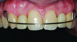 Fig 6. The patient requested zirconia-based resin-bonded FDP because the teeth were previously prepared for such restorations. Tooth preparation for retainers was extended
incisally, gingivally, and interproximally to include the entire lingual surface of the abutment teeth. The depth of the preparation on the cingulum was kept at 0.75 mm with light gingival and interproximal chamfer. Laboratory instructions included layered zirconia restorations on the pontics, monolithic zirconia for the retainers, and light occlusal contacts in MI with functional occlusal contacts on the canines. As shown here, the patient was provided a Hawley retainer with prosthetic teeth replacing Nos. 7 and 10.