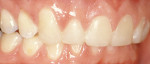 Figure 3  Final composite restorations restore length. Abfractive lesions on the facial are restored as well.