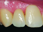 Fig 8. Frontal sagittal views of resin-bonded zirconia-based restorations. Restorations were permanently bonded with light-cured translucent luting resin (eCement, Bisco Inc.).