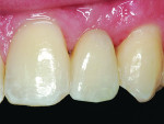 Fig 9. Frontal sagittal views of resin-bonded zirconia-based restorations. Restorations were permanently bonded with light-cured translucent luting resin (eCement, Bisco Inc.).
restorations.