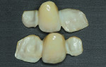 Fig 7. Lingual views of zirconia-based restorations. Intaglio surfaces of restorations were lightly sanded with 50-μm alumina at 5-mm distance from the restorations and at a
pressure of 2.8 bars for 20 seconds. Z-Prime™ Plus (Bisco Inc.) was applied to the retainers 5 minutes in advance of clinical try-in. Prostheses were tried in for proper fit and occlusal
contact. Try-in was performed with eCement® (Bisco Inc.) light-cured translucent luting resin. Restorations were cleaned using acetone for 5 minutes removing excess with a gentle flow of air. Preparations were pumiced using fine
flour pumice, briefly etched using 37% phosphoric acid gel, and primed using All-Bond Universal® (Bisco Inc.). Excessive primer was removed using a gentle flow of air, and light-curing was done following the manufacturer’s instructions.