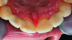 Fig 10. Palatal view of resin-bonded zirconia-based restorations