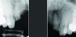 Fig 1. The patient presented with a failing bridge from teeth Nos. 7 through 10. Tooth No. 10 had a significant periapical radiolucency and periodontal ligament space widening around
most of the root.