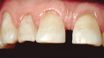 Figure 5  The patient had composite restorations to restore the abfractive lesions on the labial.