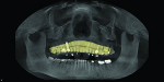 Fig 3. A CEREC Omnicam was used to obtain an optical impression of the patient’s maxillary dental arch. These data were merged with the GALILEOS CBCT image to plan the dental implant position and orientation based on the final prosthesis.