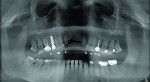 Fig 2. A GALILEOS CBCT scan was obtained to evaluate the dental pathology and bony architecture. Scanning was performed using a special bite plate with multiple radiopaque
fiducial markers, with Futar® Scan (Kettenbach) used as bite-index material. This bite plate would be converted into the surgical guide by SICAT, a Sirona company.
