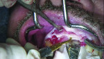Fig 7. After surgical access to the alveolar ridge was accomplished, teeth Nos. 7 and 10 were removed. Then, using a Piezosurgery saw, an osteotomy, approximately 15 mm in depth, was made across the surgical site.