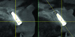 Fig 13. Cross-sectional views of the CBCT demonstrated that the dental implants were placed into the planned positions, with the fixture apex in stable alveolar ridge and the cortical expansion provided by the ridge-split osteotomy providing adequate bone thickness both facial and palatal to the implants.