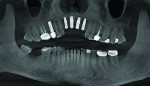 Fig 12. Panoramic reconstruction view of the postoperative CBCT scan image showed four ideally spaced, parallel dental implants at the crest of the expanded alveolar ridge.