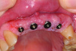 Fig 15. Two weeks after implant uncovering,
healthy keratinized tissue surrounded the healing abutments. The patient was then referred to his general dentist for prosthetic
restoration of the four dental implants.