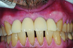 Fig 17. Two months after placement of the final restorations, a wide band of keratinized gingival tissue was evident adjacent to the implant-supported prostheses. In the interproximal spaces, the contour of the crowns facilitated migration of keratinized tissue to form interdental papillae.