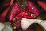 Fig 14. After allowing 4 months for healing
of the bone graft and osseointegration of the four implant fixtures, the surgical site was re-entered using a serpentine crestal incision. The ridge had fully healed, and healthy bone was covering the implants and in the osteotomy space.