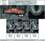 Fig 5. The GALILEOS planning report indicated that sufficient alveolar ridge height existed for 15-mm-long implants. However, a deficiency in the required 2 mm of buccal and palatal bone surrounding the implant fixtures when placed in the ideal positions prompted the treatment plan to include alveolar ridge splitting to both the buccal and palatal to achieve sufficient bone thickness around each implant.