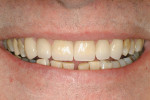 Figure 7  Final porcelain veneers. The patient subsequently elected to restore the maxillary premolars. Laboratory work courtesy of Jurim Dental Studio.