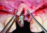 Fig 8. Clinical photograph showing approximation of the double papillae flap by 6-0 silk interrupted sutures.