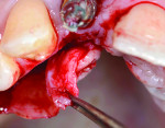 Fig 10. A subepithelial connective tissue graft was rotated from the palate toward the labial side.