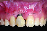 Fig 7. Clinical photograph showing the inverted V-shaped incision labially, which follows the outline of the gingival recession to perform the
double-papillary flap approximation.