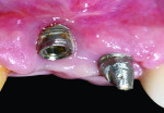 Fig 15. Clinical photograph of Class II division 2 implantrelated gingival recession that demonstrated more than 3 mm of apical migration of the local tissues.