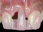 Fig 4. Acrylic template used to record the improvement of implant-related gingival recession. Note the improvement in the tissue
height in an incisal direction.