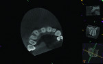 Fig 2. CBCT radiograph exposed 7.5 years later showing the bone dimensions in the cervical region between the maxillary right central incisor and canine teeth.