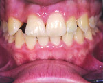 Fig 1. Facial view of a healthy 16-year-old female taken at the completion of her orthodontic treatment and prior to the placement of a resin-bonded fixed partial denture. Note a slight dissimilarity in gingival
margins between the 2 central incisors and yet their incisal edges
were virtually even.