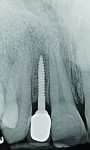 Fig 6. Radiograph of the cemented crown exposed 3 months after insertion.