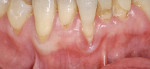 Figure 10  The patient exhibited recession around several mandibular anterior teeth. Tooth No. 25 was especially sensitive and recession was getting worse. The patient found it hard to maintain and there was a frenum pull present.