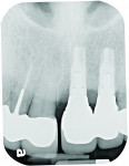 Fig 11. Radiograph exposed at this time, though not standardized, suggested an increase in the angle to the osseous deformity. Boneheight
stability had remained around both the implant
and teeth, suggesting that the increase in interproximal pocketing was related to peri-implant inflammation, ie, peri-implant gingivitis, and not peri-implantitis.