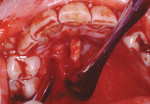 Figure 11  A subepithelial connective tissue graft was obtained from the palate.