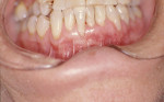Figure 13  Although complete coverage was not obtained, the gingival margin was coronal to where it was originally and more readily maintained with a zone of attached tissue. The patient exhibited no more sensitivity.