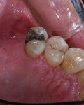 Pretreatment condition showing disto-occlusal amalgam on tooth No. 13.