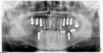 PAN displaying implants and dentition at comprehensive exam and records appointment.