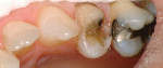 Figure 14  The patient exhibited pain on biting and sensitivity to cold on tooth No. 12. The fractured buccal was removed and the tooth prepared for a porcelain onlay veneer.