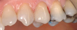 Figure 15  The onlay veneer was placed restoring function and esthetics. Laboratory work courtesy Jurim Dental Studio.