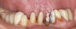 Figure 17  The teeth were prepared for porcelain veneers on teeth Nos. 22, 25, 26, and 27. Teeth Nos. 23 and 24 were restored with splinted PFM crowns (because of the poor crown-to-root ratio). It had been suggested to extract these teeth and place a