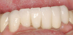 Figure 18  Final restorations improved the color and alignment of the teeth. Gingival heights were not addressed and were not visible. Laboratory work courtesy Americus Dental Laboratory.