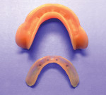 Figure 1  Retrofitted denture and Tuf-Link reline.
