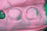 Figure 4  Impressions made in less than ideal gingival conditions.